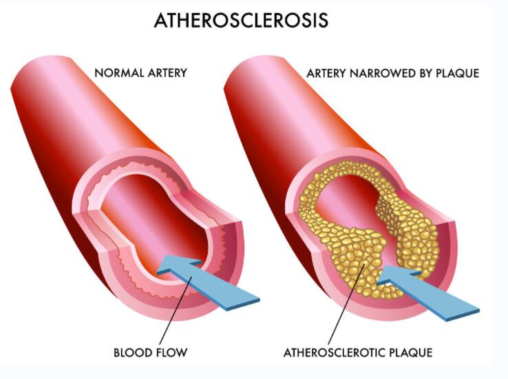 动脉粥样硬化