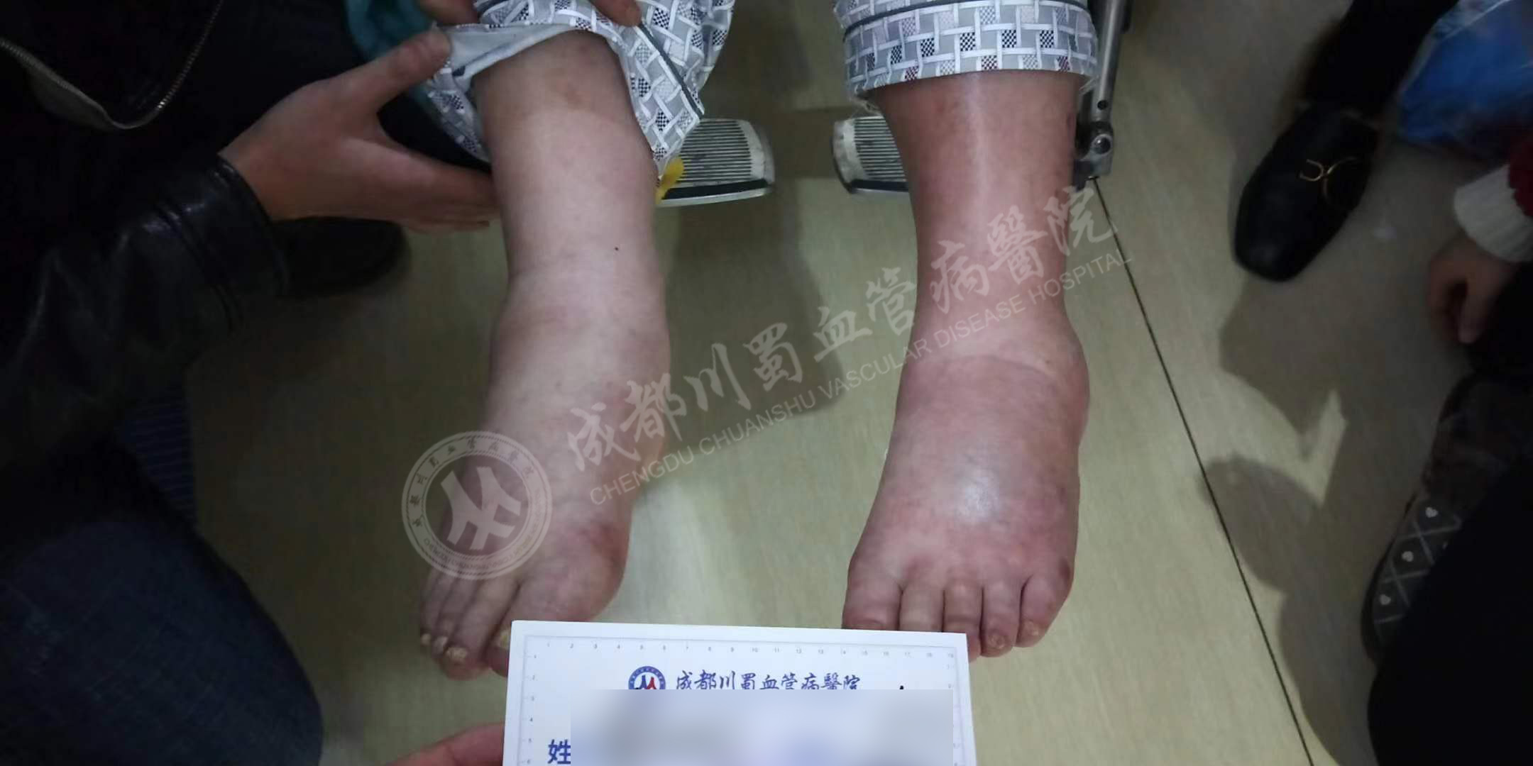 深静脉血栓 (3)
